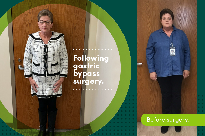 Julie Long before and after bariatric surgery
